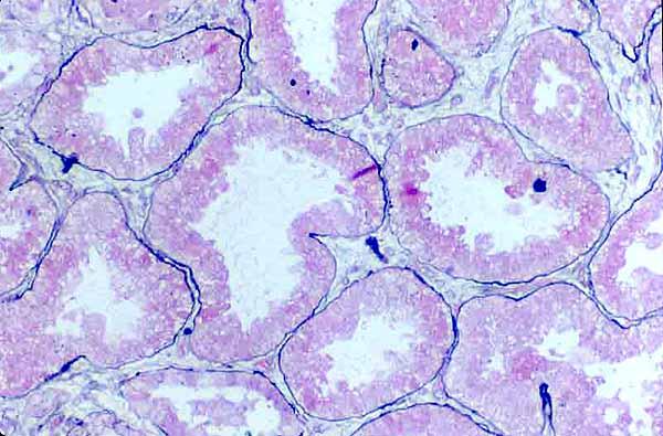 noodzakelijk 21 Rejectie / Afstoting Acute rejectie (afstoting) Immuunuppressiva Eigen afweer Treedt met