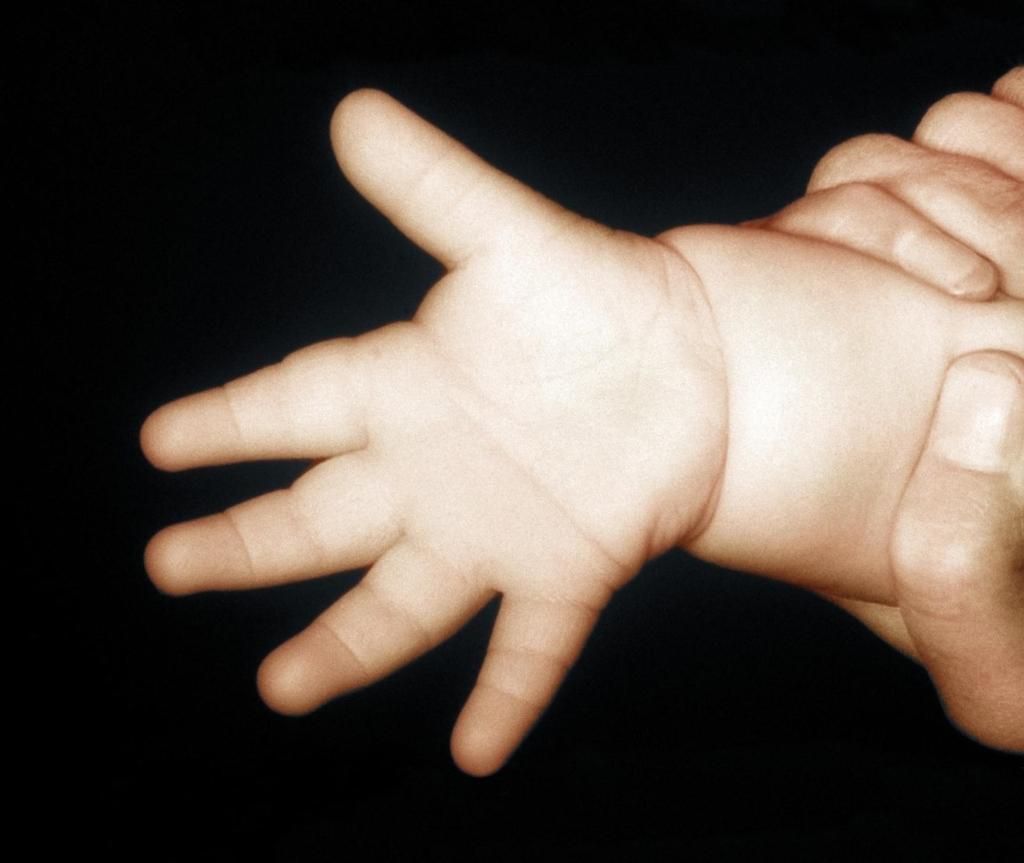 <p>een handje van een baby met het syndroom van Down. <span class="credit">blg</span></p> Een handje van een baby met het syndroom van Down.