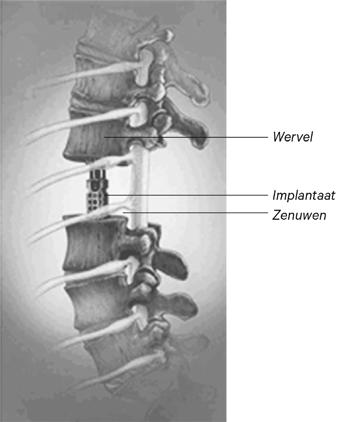 Als er geen implantaat hoeft of kan worden geplaatst, dan worden alleen de wervels aan elkaar vastgezet.