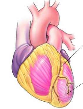 Vrouwelijk patroon van coronairsclerose Minder vernauwingen kransvaten (vooral < 65 jaar) Diffuser patroon