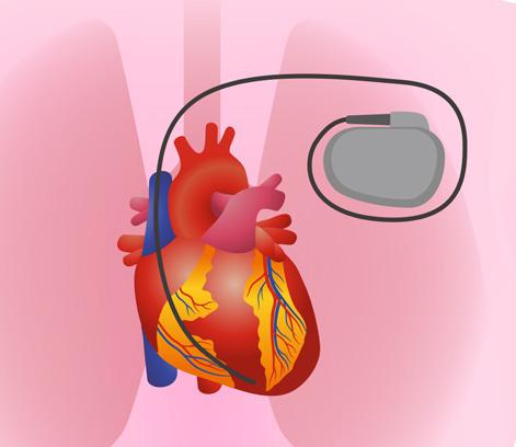 Pacemaker Hartritmestoornissen kunnen op diverse manieren worden behandeld. Wanneer medicatie niet effectief is, kan een pacemaker uitkomst bieden.