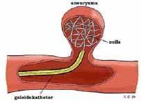 Behandeling via de liesader (coiling) U krijgt een slangetje in de liesslagader, waarmee vervolgens het aneurysma van binnenuit opgevuld wordt met een ballonnetje of platina spiraaltje ( coil ), of