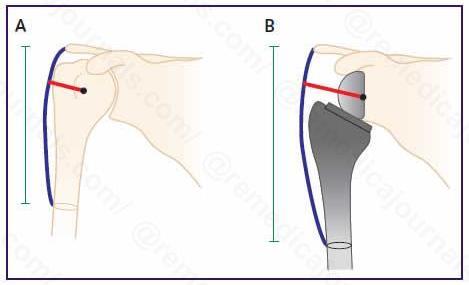 Reversed schouderprothese Voorwaarde: functionele deltoideus en