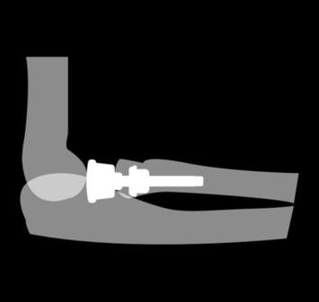 Hoe ziet een elleboogprothese eruit? Er bestaan verschillende elleboogprotheses: 1. Radiuskop prothese De radiuskop prothese vervangt alleen de kop van het spaakbeen.