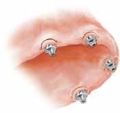 Klinische tip: Plaats bij mandibulaire protheses de Gold-Tite- of titanium borgschroeven (LPCGSH of LPCTSH) in de toegangsopeningen voor de schroeven van de prothese en plaats daarna de tijdelijke