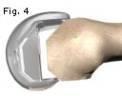 Vervolgens wordt de knieschijf erop geplaatst (figuur 5) en kan de wond dichtgemaakt worden. Waarom een totale knieprothese?
