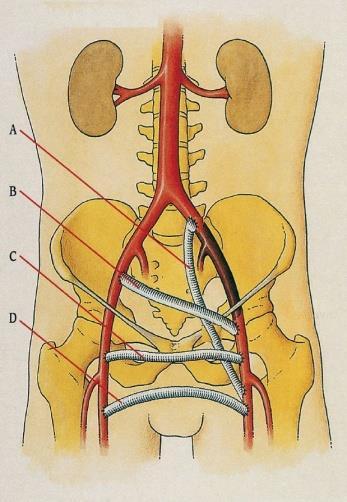 Soms moet men een overbrugging aanleggen tot in het onderbeen omdat hogerop het bloedvat niet meer doorgankelijk is. Dit noemt men een femoro-tibiale bypass.