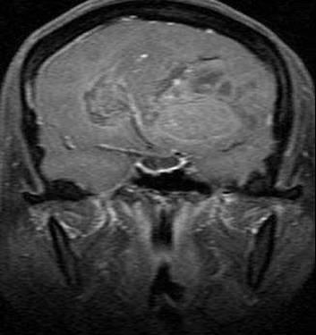 MRI T1W1 with contrast