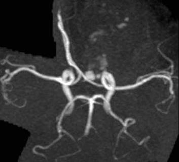 MRA Anterior cerebral arteries displaced to the right