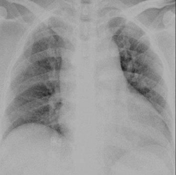 Chest X-ray X (92.6.