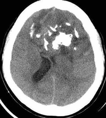 Non-enhanced brain CT 2 Left lateral ventricle compression and Foramen of Monro obstruction, result