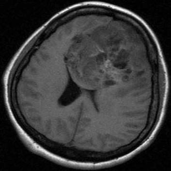 MRI T1W1 Large multilobulated irregular mass with perifocal