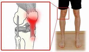 Kniepeesontsteking Pijn juist onder de knieschijf Pijn vooral na het lopen Pijn bij knielen en