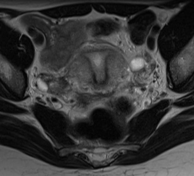uterus MRI