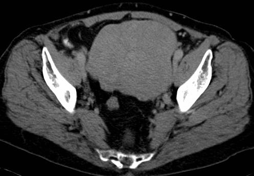 Uterus Myomatosus CT Vaak zelfde densiteit als myometrium Diagnose obv uitpuiling /