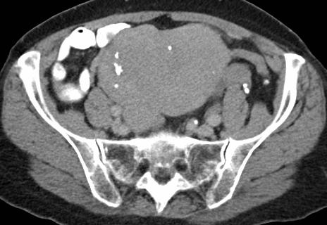 Uterus Myomatosus CT Vaak zelfde densiteit als myometrium Diagnose obv uitpuiling /