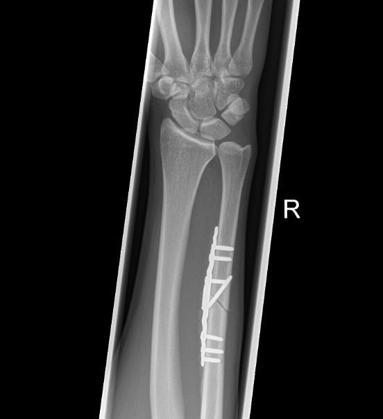 De operatie De operatie vindt plaats met een blockverdoving van de arm of onder algehele verdoving (narcose). Dit heeft de anesthesioloog met u besproken.