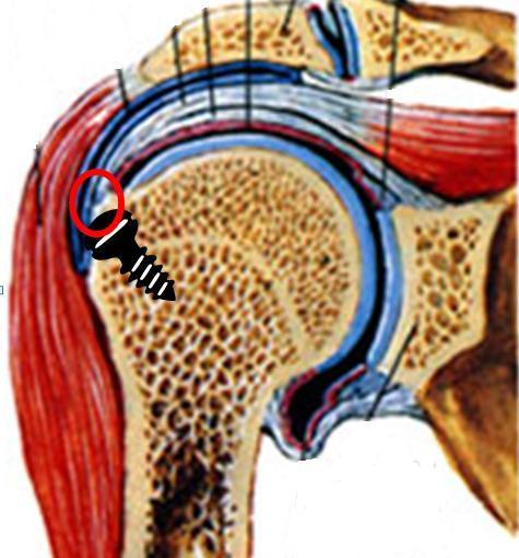 Een acute scheur in de pezen van de rotator cuff ontstaat meestal door een trauma, zoals een val.