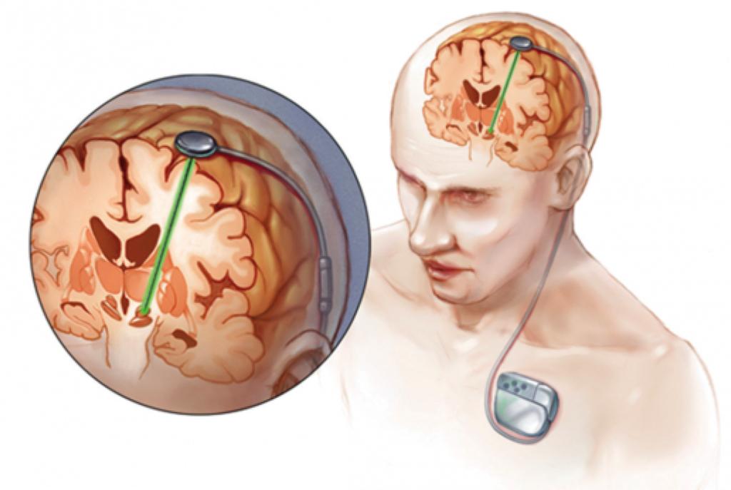 Diepe hersenstimulatie Nieuwe behandelingsmethode