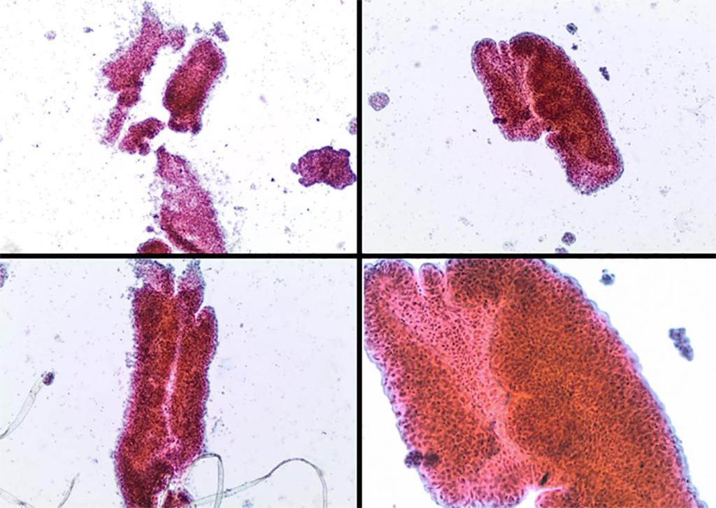 VI. Low Grade Urothelial