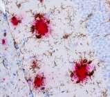 Microglia, ontsteking en Alzheimer Alzheimer s Neuropathologie (weefsel van donor): microglia activiteit in