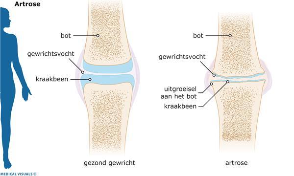 Artrose knie Wat is artrose? Artrose is een aandoening die voor kan komen bij één of meerdere gewrichten. Een gewricht bestaat uit twee botuiteinden, die zijn bekleed met kraakbeen.