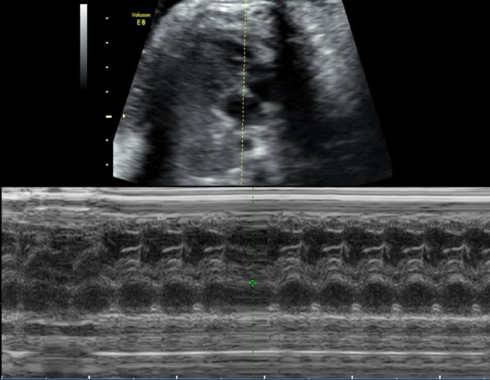 42 jarige G2P0 Bekend met hypothyreoïdie en uterus myomatosus SEO: normaal.