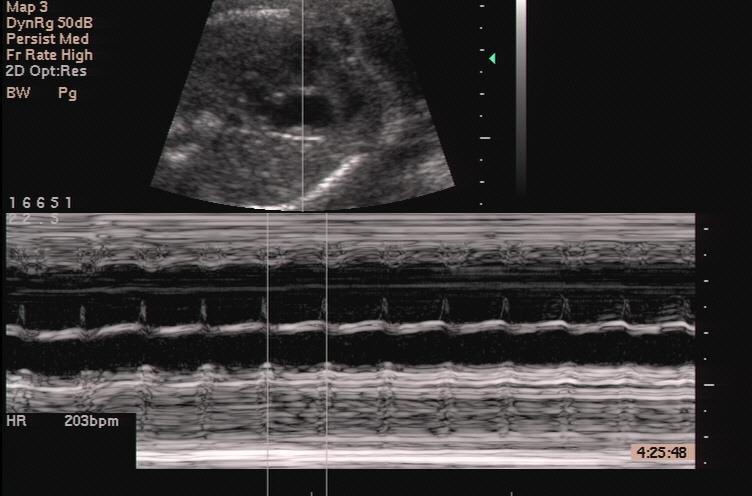 Tachycardie: hartritme > 180-200 slagen per minuut Sinustachycardie