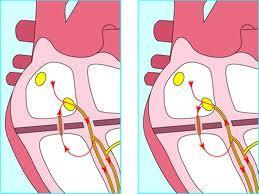 Supraventriculaire tachycardie: HR 220-240 bpm Ectopische