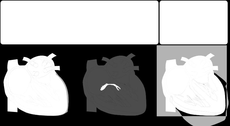 Supraventriculaire extrasystole (SVES) = premature atriale contractie