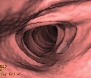 Wanneer een klassieke coloscopie (links) niet mogelijk is, kunt u verwezen worden voor medische beeldvorming van de dikke darm door een virtuele coloscopie of CT-colonografie (rechts).