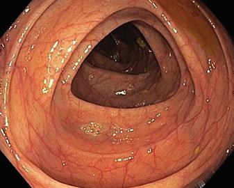 De dikke darm bestaat uit vier delen: colon ascendens of het stijgende gedeelte, colon transversum of het dwarse gedeelte, colon descendens of het dalende gedeelte en ten slotte het sigmoïd, het