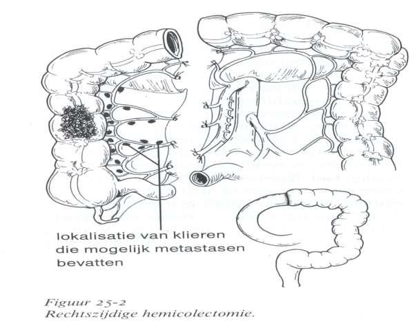 Colorectaalcarcinoom Behandeling coloncarcinoom Verwijderen deel van de darm Verwijderen