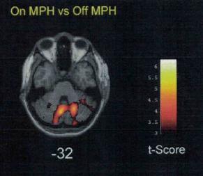 prefronto-centro-caudato-cerebellaire activiteit correlerend met MPH 3.
