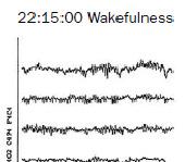 17 Figuur 15: EEG opnames van een persoon tijdens waken (links), SWS (midden) en een episode van slaapwandelen (rechts) (Bassetti 2000).