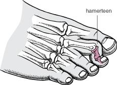 Inleiding Een hamerteen is een teen die in een buigstand staat, waarbij het middelste gewrichtje van de teen hoger staat (zie figuur 1). Deze stand kan voor pijnklachten zorgen.