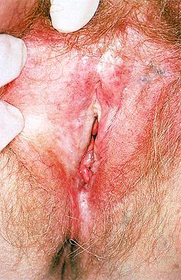 vulvacarcinoma (3-5%) vulvaletsel,