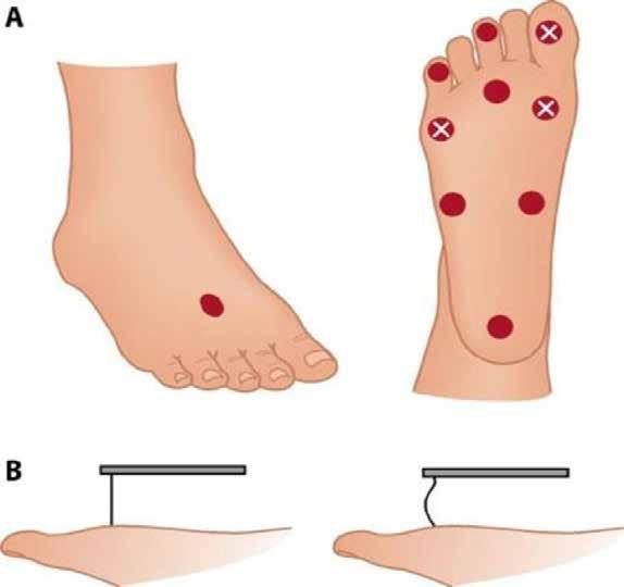 MONOFILAMENT TEST A Een monofilament test is een snelle, bruikbare en goedkope methode om neuropathie te testen. De patiënt ligt op zijn rug met de ogen gesloten.