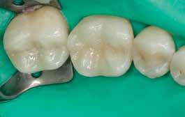 Casus 2 leden een endodontische behandeling gedaan die er prima uitziet en waar nu De tweede patiënte komt binnen met een grote composietrestauratie aanwezig is.