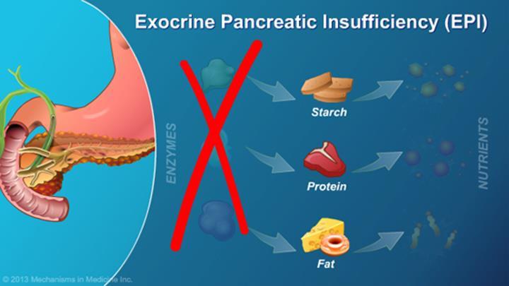Exocriene pancreasinsufficiëntie (EPI) Ten gevolge van: Acute pancreatitis / Chronische pancreatitis Cystic Fibrosis Galwegobstructie (galzouten diarree) Bacteriële overgrowth Een operatie