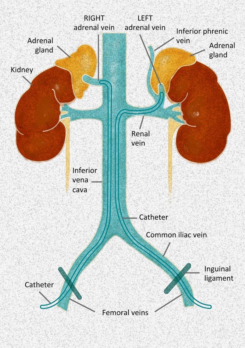 Bijniervene sampling op aldosteron Referral center Unstimulated or ACTH infusion Successful AVS Diagnosis of unilateral PA Munich, Paris Unstimulated SI 2 LI 4 Torino Unstimulated + con tinuous ACTH