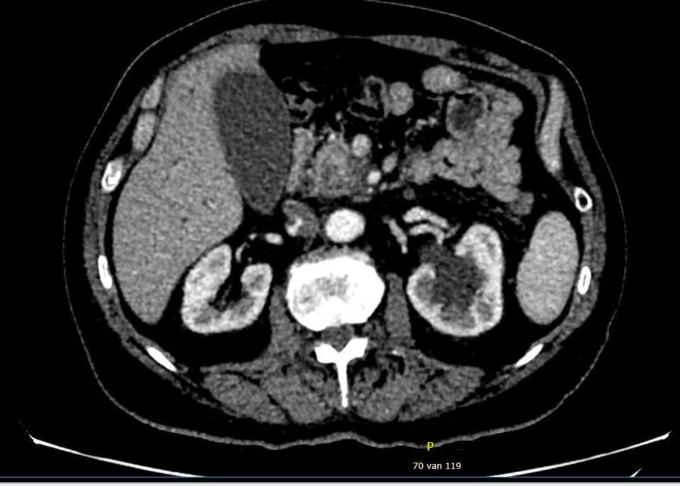 CT-scan bij