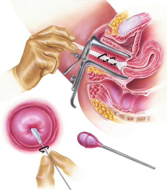 Algemeen Bij een uitstrijkje neemt de arts met een borstel of spatel cellen van de baarmoedermond af.