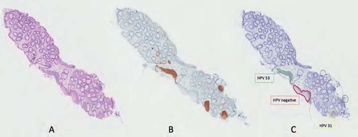 One lesion, one virus Figure 2 Single vs.