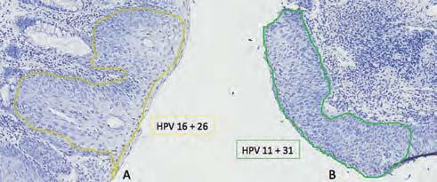 Chapter 9 Figure 3 Multiple HPV types in two regions H-stained membrane slides.