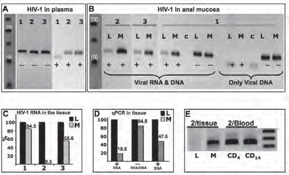HIV activity in AIN Figure 1: A: HIV-1 LTR amplification in Plasma of patients 1, 2 and 3 with or without DNAse I in order to distinguish RNA from DNA.