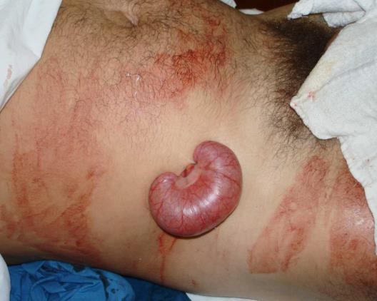 Indicatie voor laparotomie na steekwond van het abdomen Hemodynamische instabiliteit