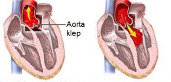 7 Aortaklep