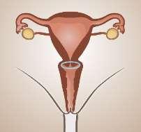 Hormonale methoden : oestrogeen + progestageen Vaginale ring (Nuvaring, Izzyring, Circlet ) o EE 0.