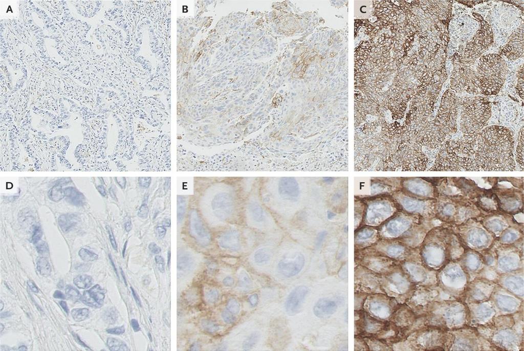 PD-L1 (22c3) expressie in NSCLC Probleem: PD-L1 kleuring is